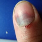 Nagelproblemen- en afwijkingen aan vingers en tenen
